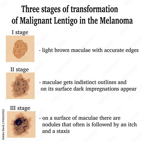 lentigo maligna melanoma stages